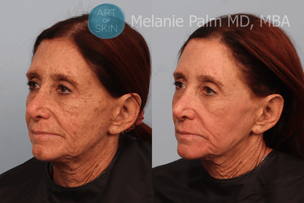Art of Skin MD Laser resurfacing before and after IPL special offer