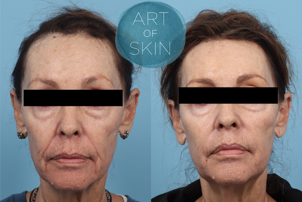 art of skin md pdo nova thread lift before and after