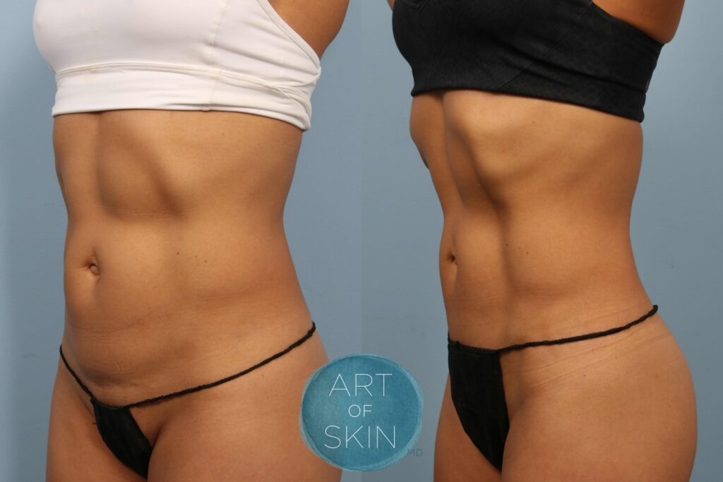 art of skin md emsculpt neo before and after