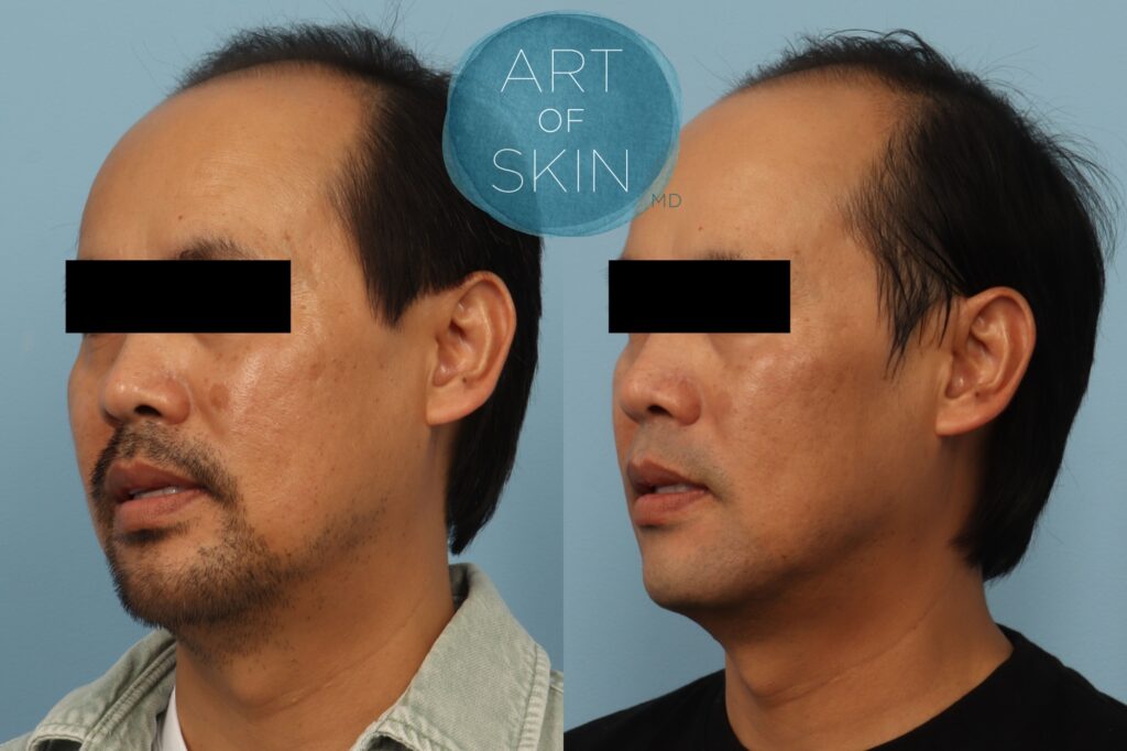 Lutronic Ultra Thulium Laser art of skin md before and afters