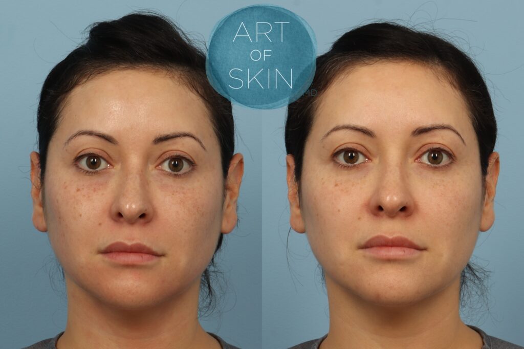 Lutronic Ultra Thulium Laser art of skin md before and afters