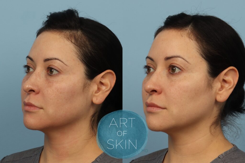Lutronic Ultra Thulium Laser art of skin md before and afters