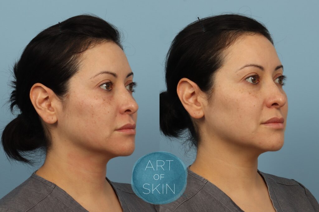 Lutronic Ultra Thulium Laser art of skin md before and afters