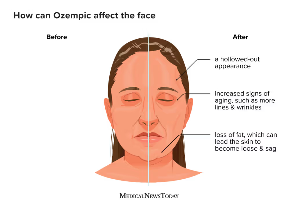 ozempic face dr melanie palm